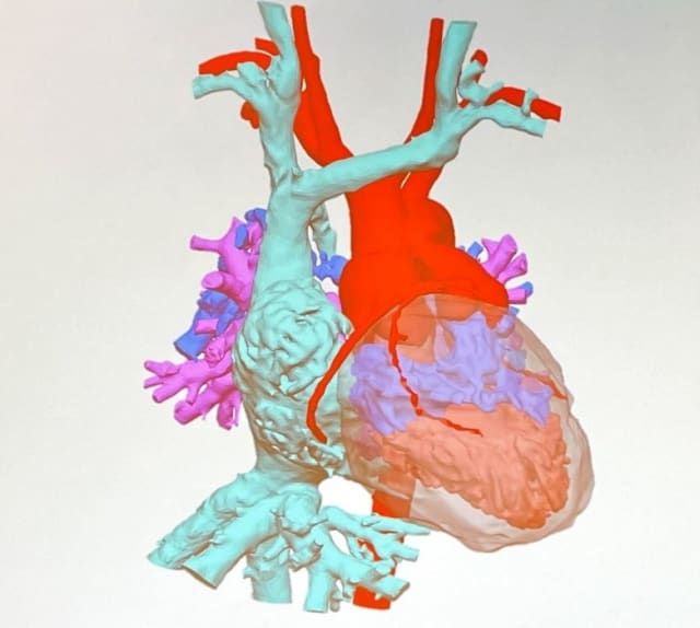 3D CT scan of child's heart is turned into an accurate 3D CAD model, with different colors representing different heart functions.